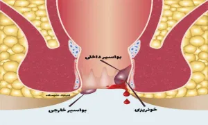 علائم و راهکارهای بواسیر داخلی