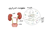 علل و درمان عفونت ادراری مکرر در بانوان