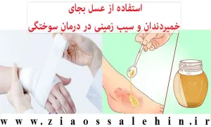 استفاده از عسل بجای خمیردندان و سیب زمینی در درمان سوختگی