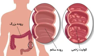 بیماری کولیت زخمی