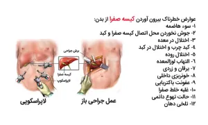 عوارض خطرناک بیرون آوردن کیسه صفرا از بدن