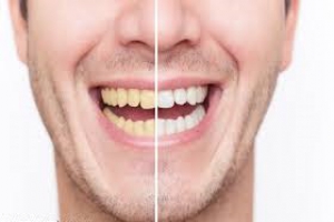 10 روش طبیعی برای سفیدکردن دندان‌ ها