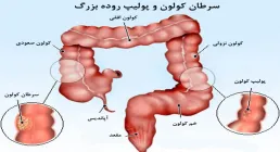 فیلم / سرطان روده بزرگ قابل پیشگیری است