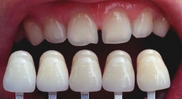 فواید و معایب کامپوزیت دندان