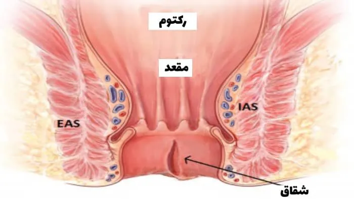 علل، علائم، تشخیص و پیشگیری شقاق مقعدی