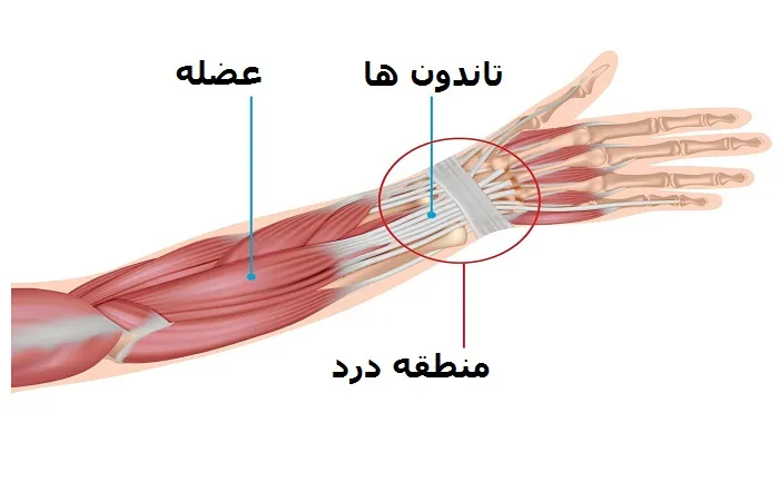 علائم و درمان تاندونیت مچ دست