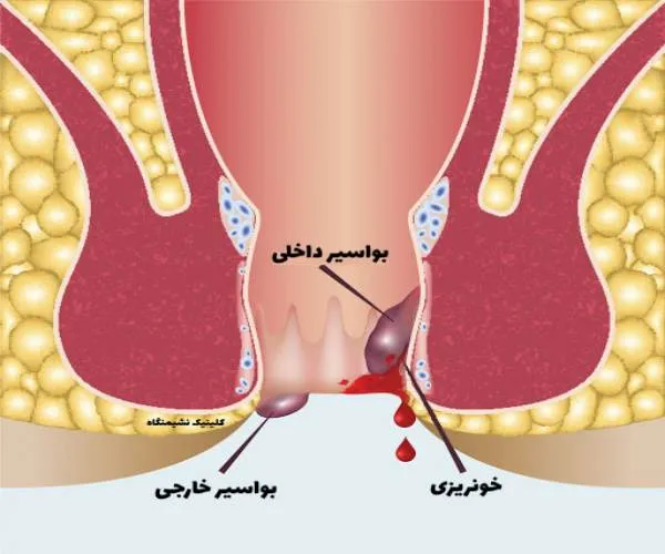 علائم و راهکارهای بواسیر داخلی