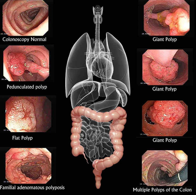 تشخیص سریع سرطان روده بزرگ با کولونوسکوپی