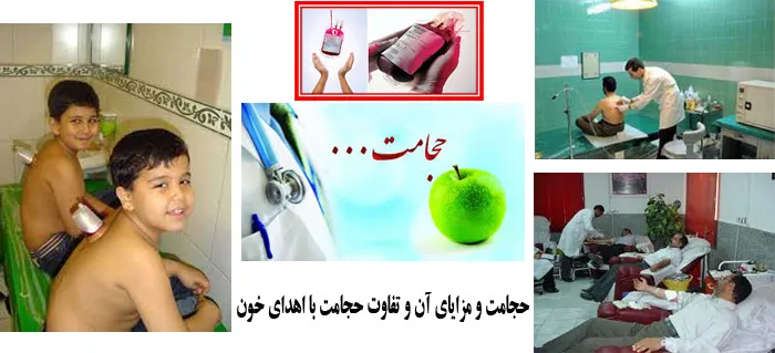  حجامت و مزایای آن و تفاوت حجامت با اهدای خون تعریف حجامت