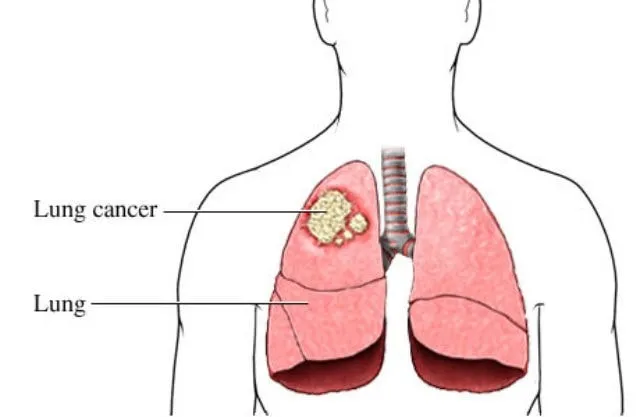 علائم سرطان ریه