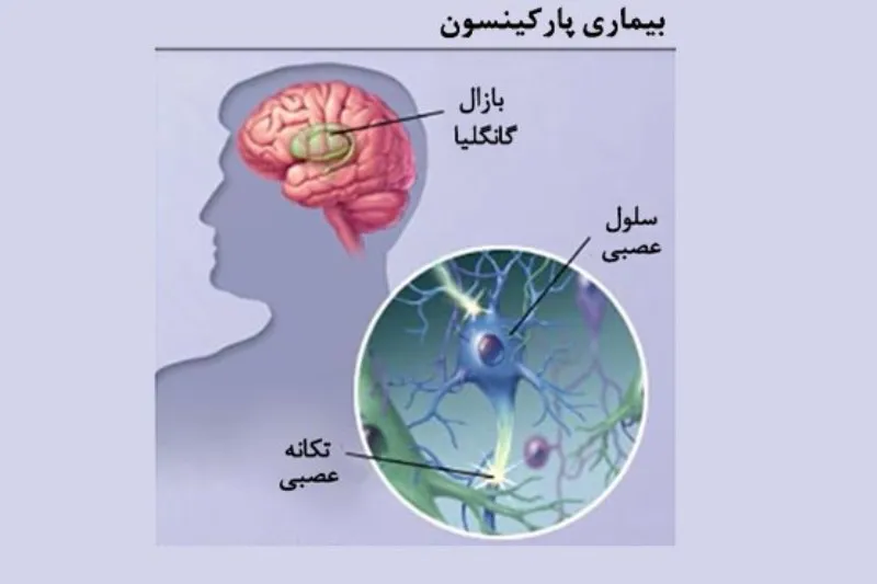 علائم پارکینسون